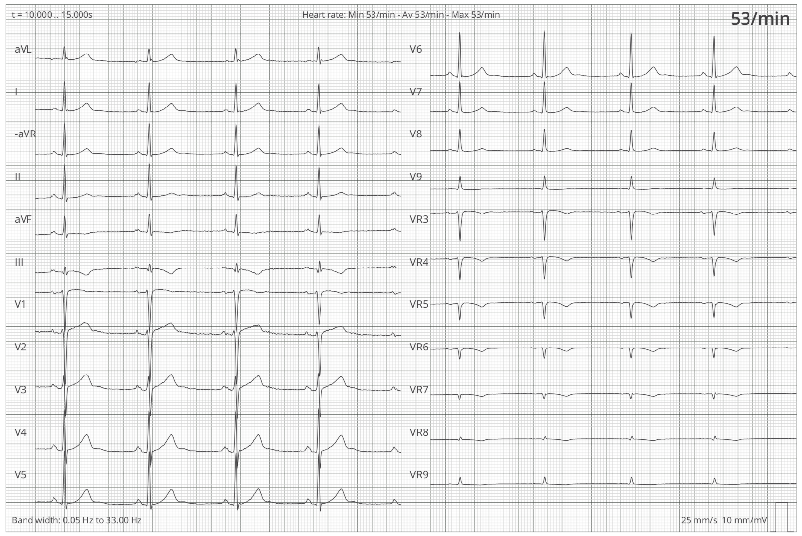 Graph showing the leads (I, II, III, aVR, aVL, aVF, V1-V9, VR2-VR9) of a 12-lead-ECG